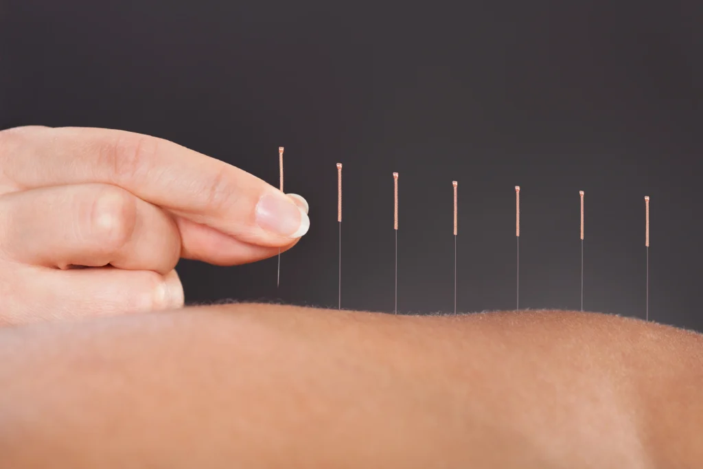 st Petersburg acupuncture specialties